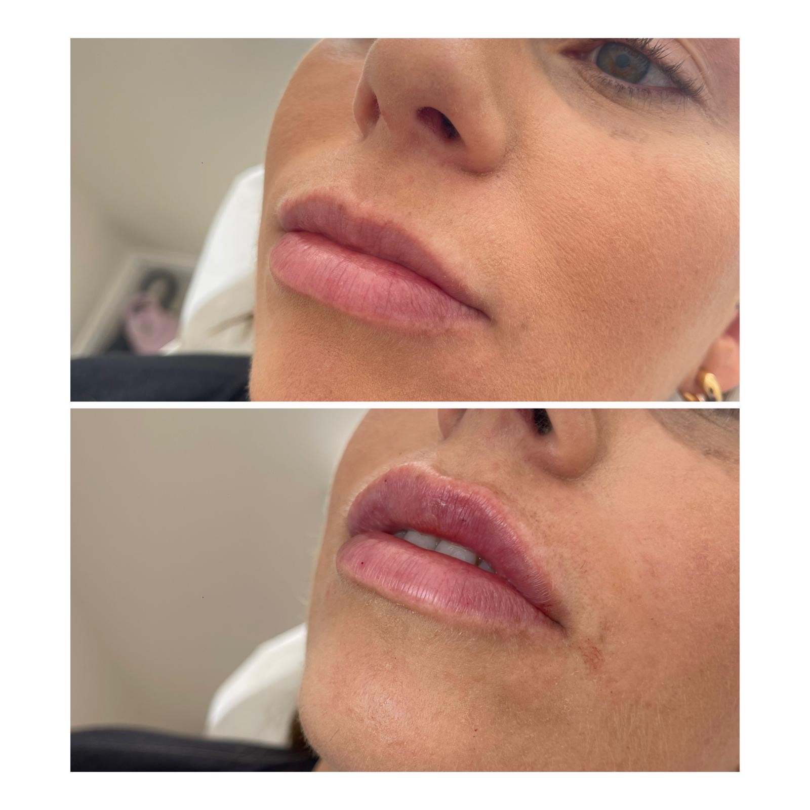 aesthetic2 before and after
